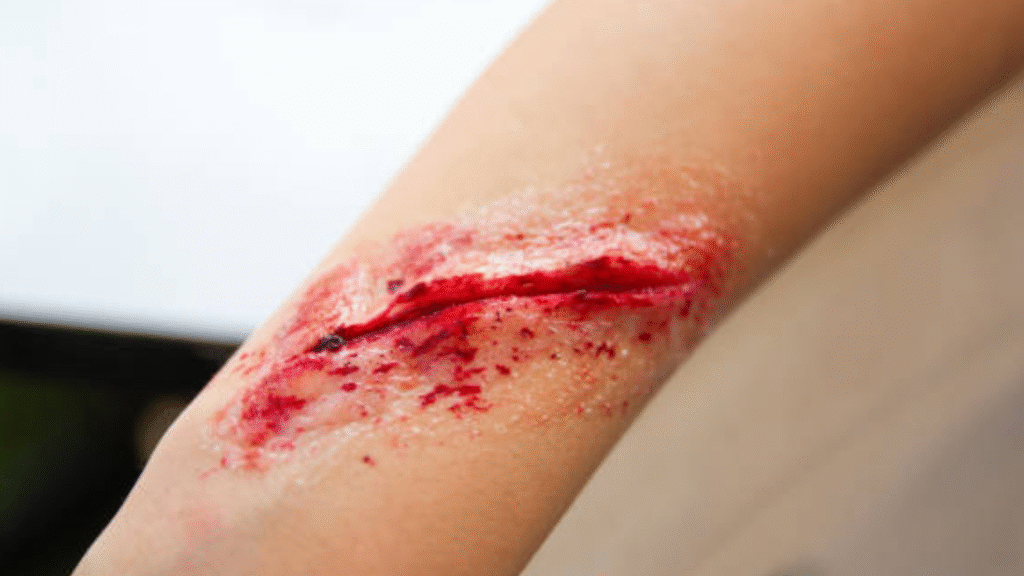 जख्म क्या है