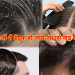 बालों में डैंड्रफ हो जाए तो क्या करें?इसके best कारण, लक्षण और प्रभावी घरेलू उपाय बताए है