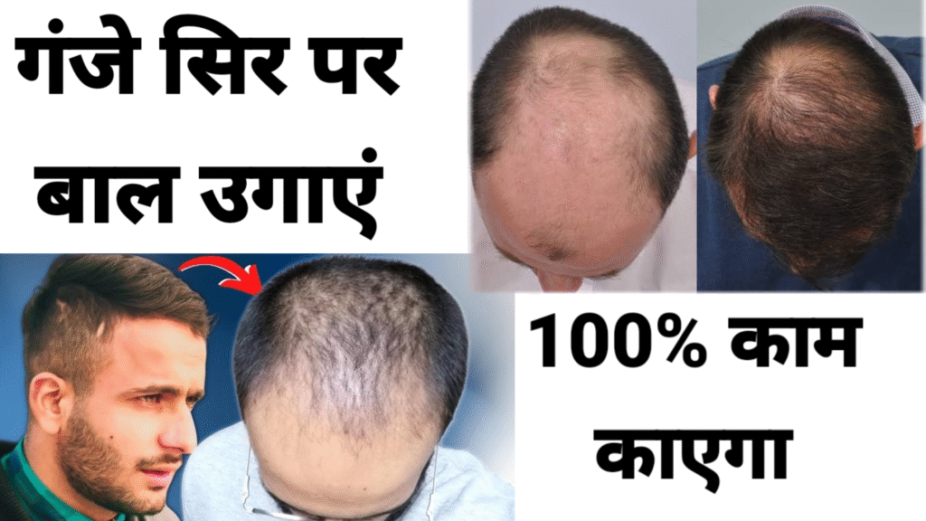 गंजे सिर पर नए बाल कैसे उगाएं? जानें 100% काम आने वाले best उपाय और घरेलू नुस्खे